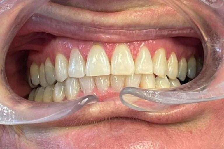 Invisalign Benfleet Cosmetic Treatments Benfleet Dental Centre