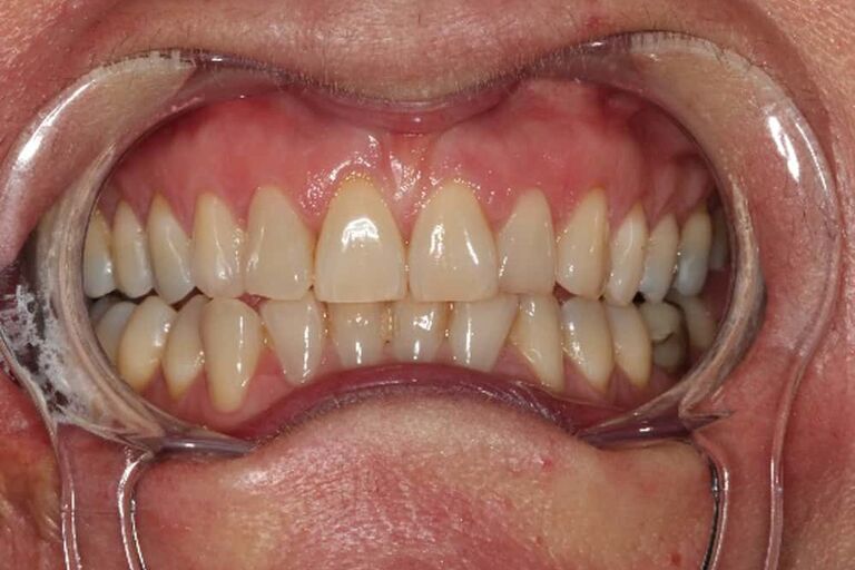 Invisalign Benfleet Cosmetic Treatments Benfleet Dental Centre