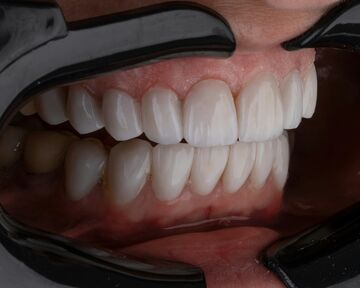 Can a Dentist Fix Chipped or Uneven Teeth