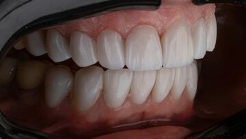 Can a Dentist Fix Chipped or Uneven Teeth