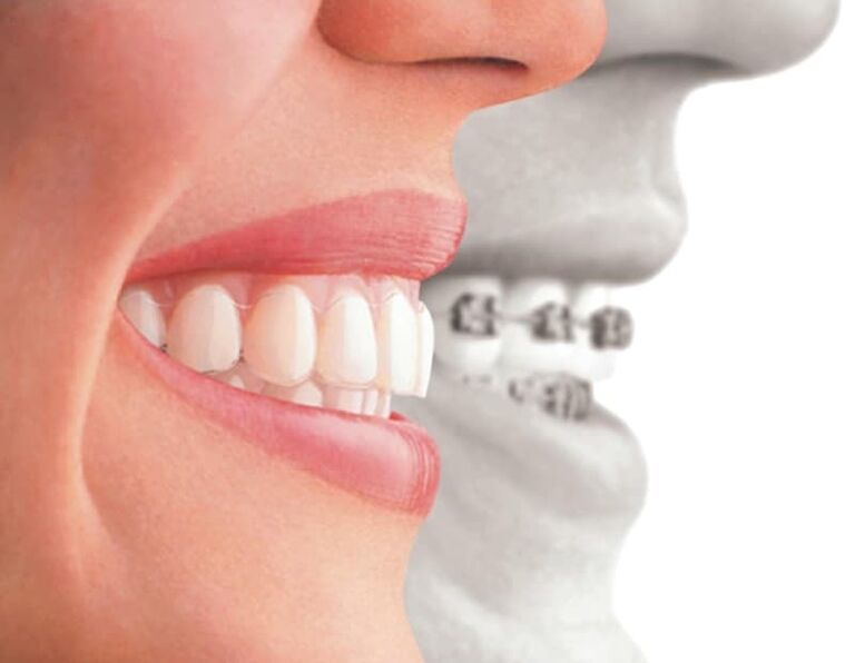 Invisalign Benfleet Cosmetic Treatments Benfleet Dental Centre