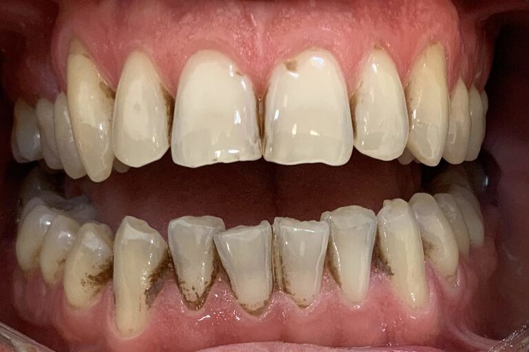 Dental Hygienist Benfleet, Hadleigh Benfleet Dental Centre